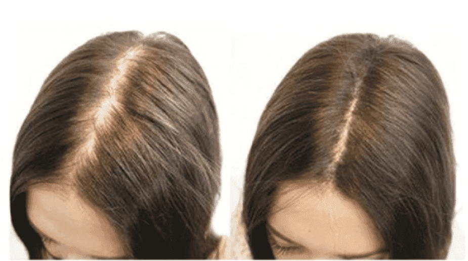 Điều Trị Gàu Nấm Ngứa Chuyên Sâu