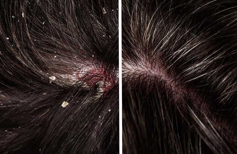 Gội Trị Liệu Gàu